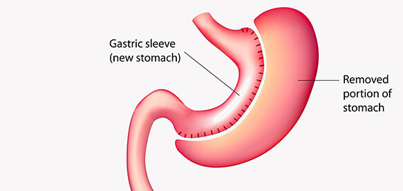 Sleeve-Gastrectomy