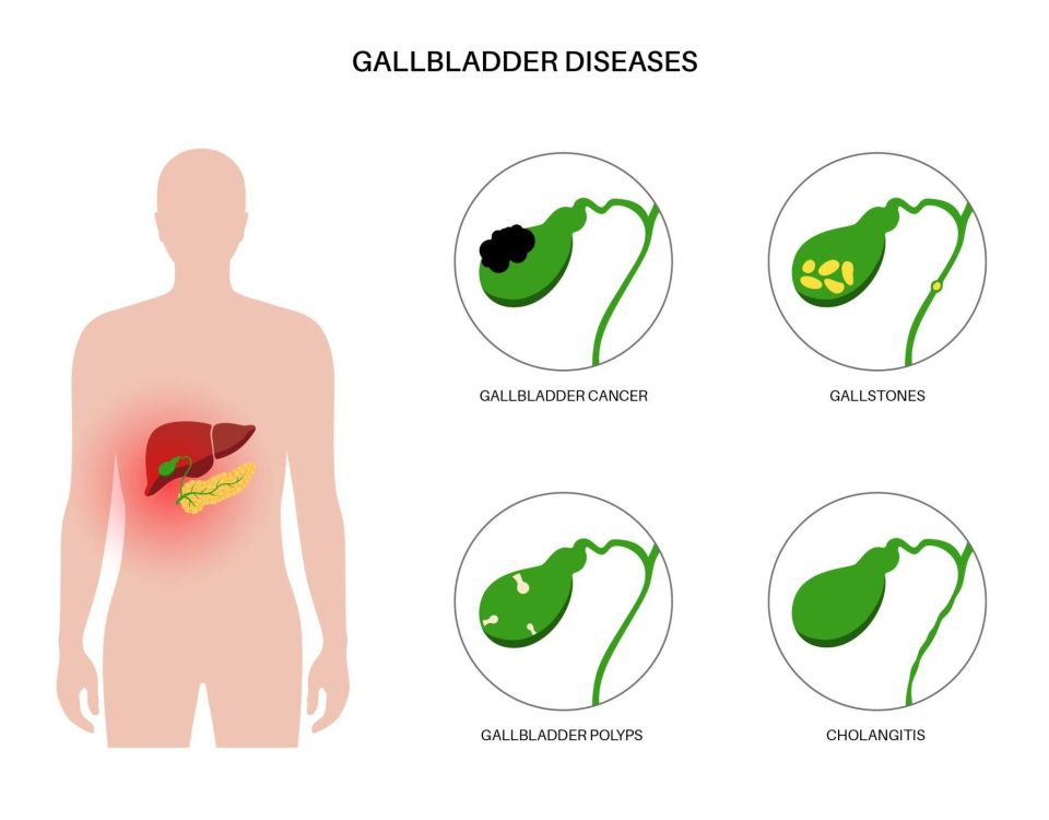 Robotic Surgery for Gallbladder Disease