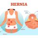Robotic Surgery for Hernias