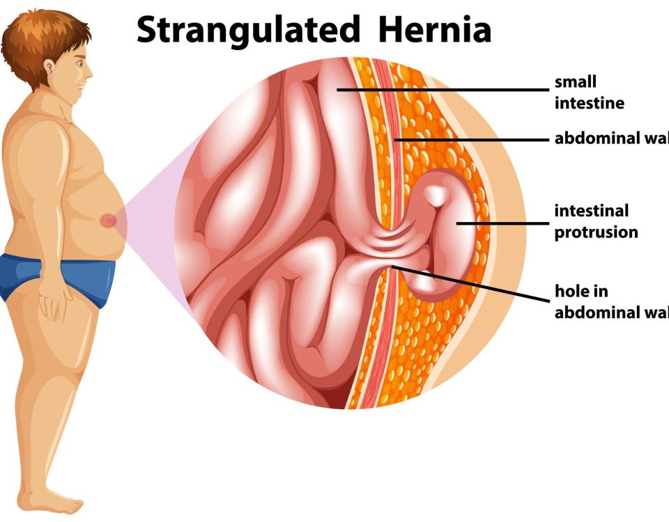 Robotic Surgery for Hernias