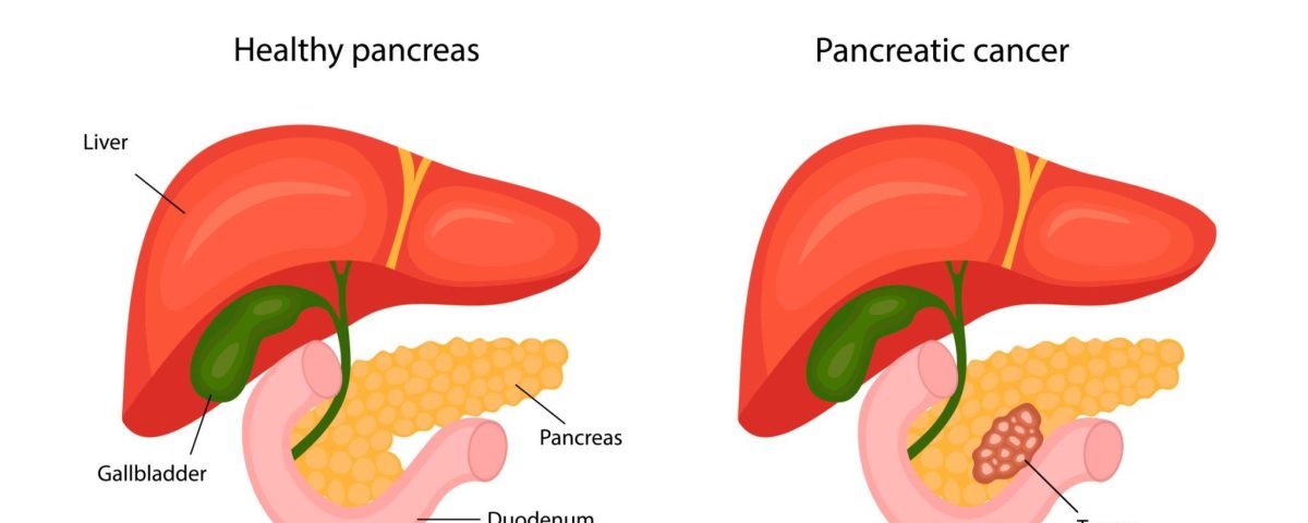 Pancreatic Cancer