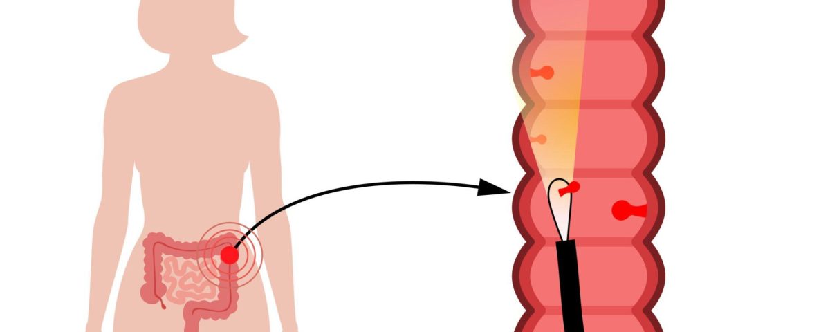 Appendix Removal Surgery