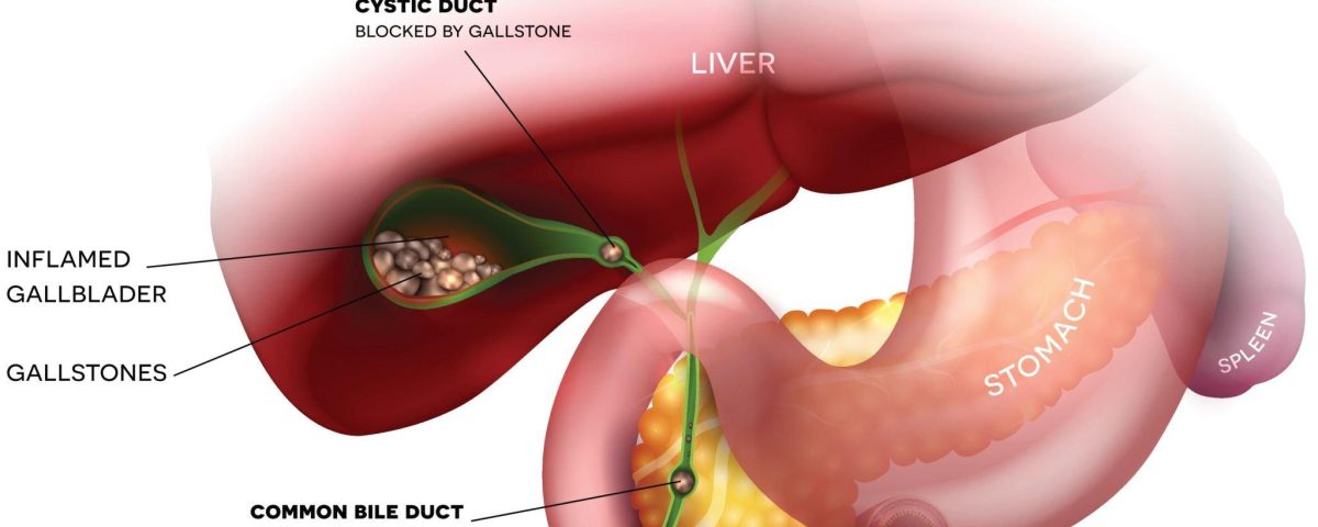 Gallbladder Cancer