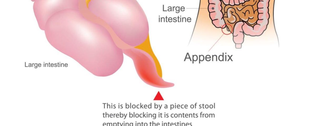 Appendix Removal Surgery